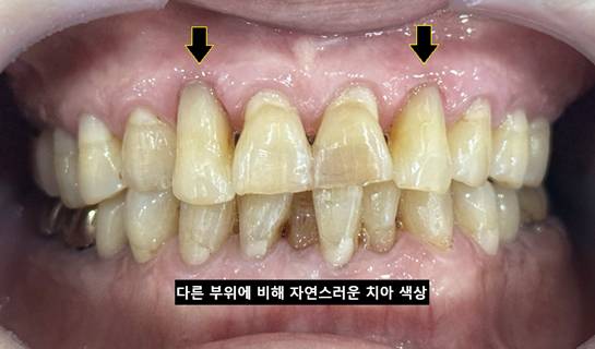 치경부 레진 치료 후 앞니 사진