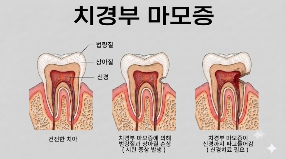치경부 마모가 법랑질과 상아질에 미치는 영향