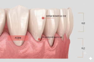 치경부레진