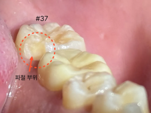 어금니 파절