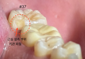 어금니 파절