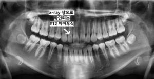 레진