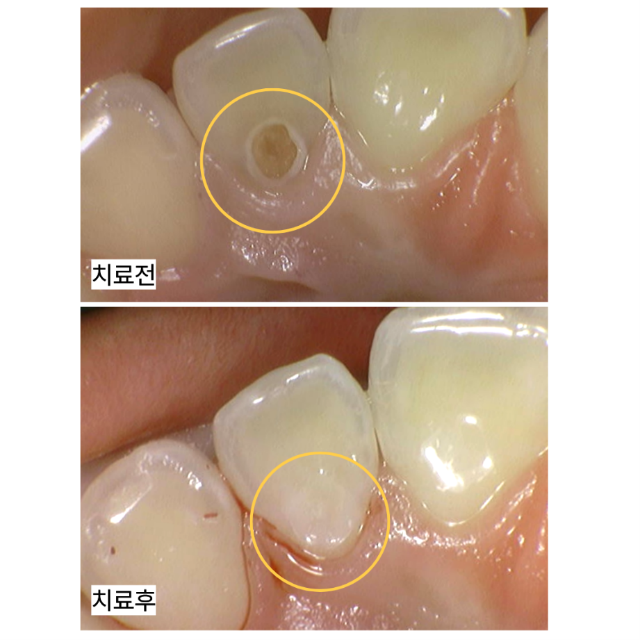 레진으로 회복한 성장기 환자분의 앞니 충치 사례-향남치과