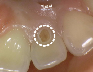 레진