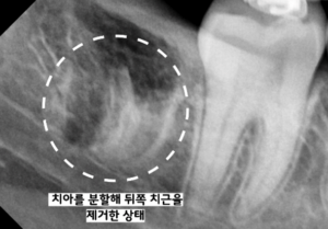 사랑니 발치