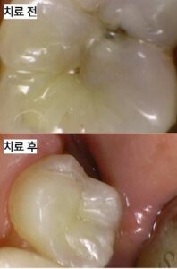 레진치료