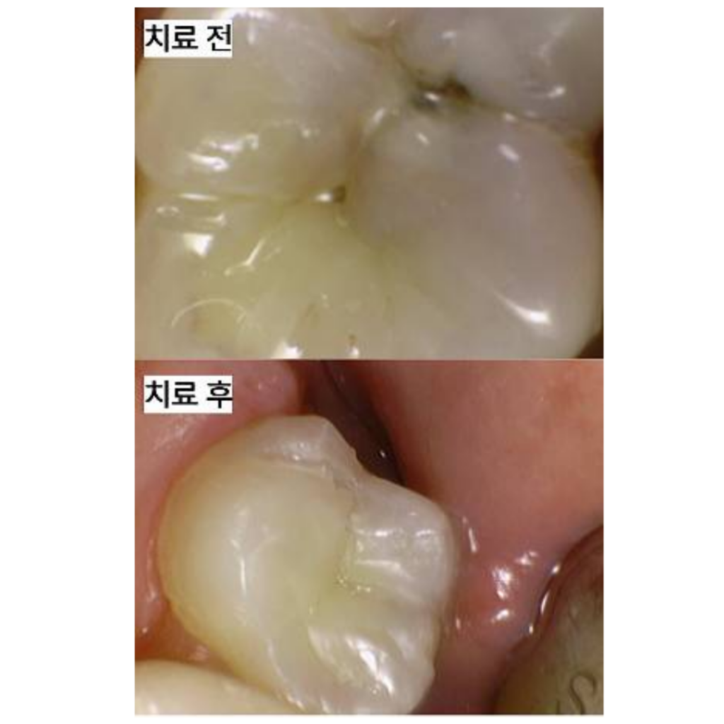 [레진치료] 깊은 충치, 인레이와 신경치료 없이 치료한 사례-향남치과