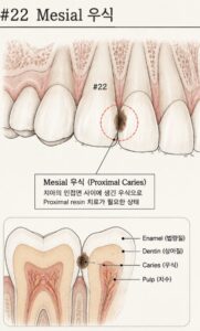 #22 앞니 인접면에 발생한 충치의 위치와 진행 부위를 설명하는 그림