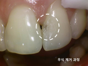 #22 앞니 사이 충치 부위를 제거한 뒤 남아 있는 치아 상태를 확인한 모습