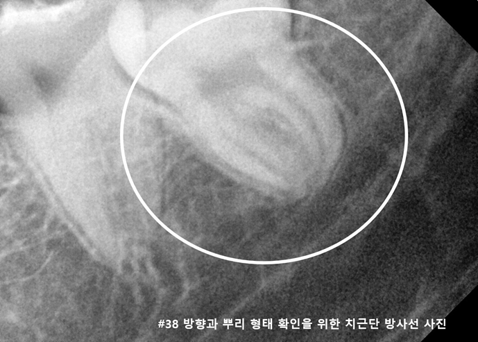 매복 사랑니 발치, 하치조신경과 가까워 분할 발치한 사례 | 믿음플란트치과