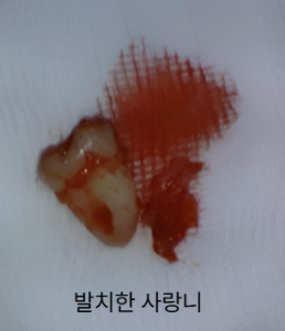 매복사랑니,사랑니발치