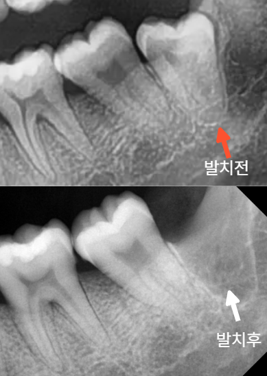 사랑니, 냄새와 잇몸 염증까지 해결한 매복 사랑니 발치 사례 -믿음플란트치과향남