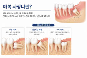 매복사랑니,사랑니발치