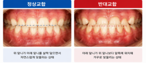 정상교합과 아래 앞니가 위 앞니보다 앞으로 물리는 전치부 반대교합의 차이를 비교한 설명 이미지