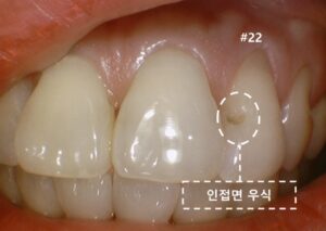 #22번 왼쪽 위 두 번째 앞니의 치아 사이 인접면에 우식이 확인되는 치료 전 구강 사진 