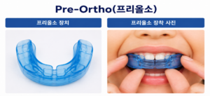 성장기 어린이가 사용하는 프리올소 가철식 교정장치와 입안에 착용하는 모습을 보여주는 설명 이미지