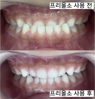 아이 앞니가 거꾸로 물릴 때, 프리올소로 시작한 성장기 반대교합 치료