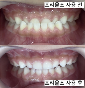 아이 앞니가 거꾸로 물릴 때, 반대교합 치료는 어떻게 선택할까요?